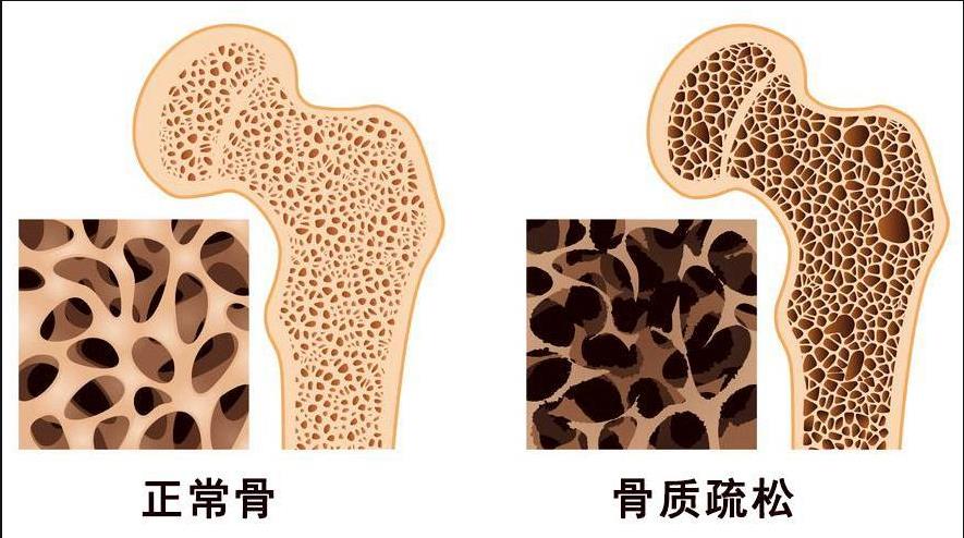 山东中仁便携式骨密度仪提醒关注-35岁以后的骨量人们要多加注意!