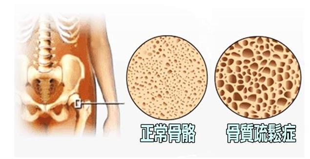 616儿童骨密度检测仪厂家-防止骨质疏松的4个小贴士,年轻人应该注意!