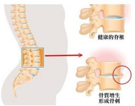 河南郑州|便携式骨密度检测仪品牌科普-骨刺的护理可是需要注意护理原则的哦!