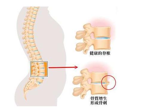 623gk超声波骨密度仪科普:骨质增生患者能通过食疗解决吗?