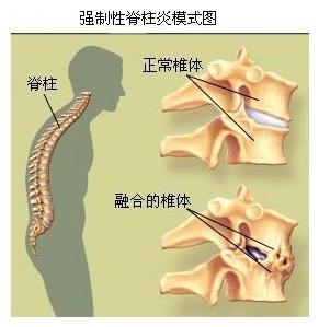 706中仁便携式骨密度仪厂家科普知识:什么是强直性脊柱炎?