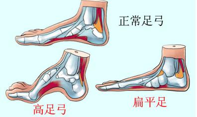 712山东中仁骨密度仪厂家提醒您-您对扁平足了解多少?