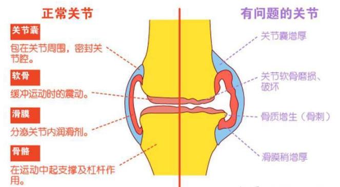 超声波骨密度检测仪品牌资讯-关节积液是什么原因引起的?如何更好的治疗?