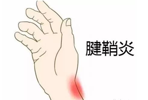 ZR骨密度仪厂家|腱鞘炎是怎么引起的?如何预防腱鞘炎呢?