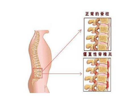 中仁便携式骨密度仪厂家分析|脊柱炎的症状与危害有哪些?